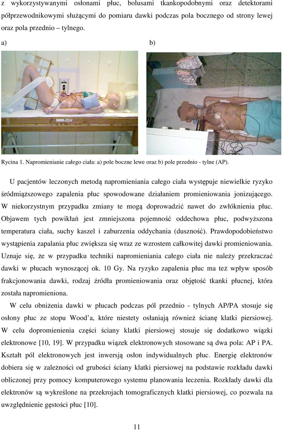 U pacjentów leczonych metodą napromieniania całego ciała występuje niewielkie ryzyko śródmiąższowego zapalenia płuc spowodowane działaniem promieniowania jonizującego.
