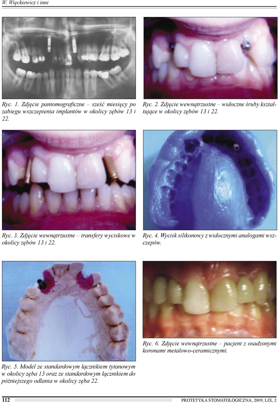 Zdjęcie wewnątrzustne transfery wyciskowe w okolicy zębów 13 i 22. Ryc. 4. Wycisk silikonowy z widocznymi analogami wszczepów. Ryc. 6.
