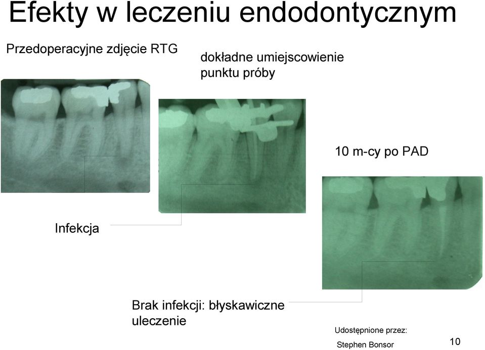 10 m-cy po PAD Infekcja Brak infekcji:
