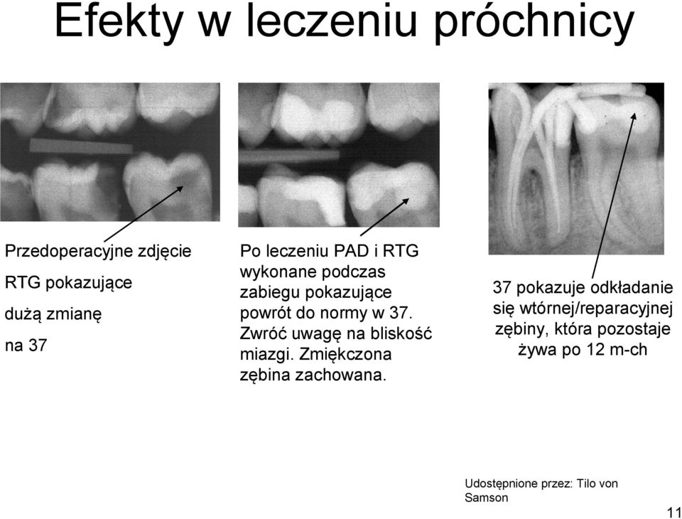 Zwróć uwagę na bliskość miazgi. Zmiękczona zębina zachowana.