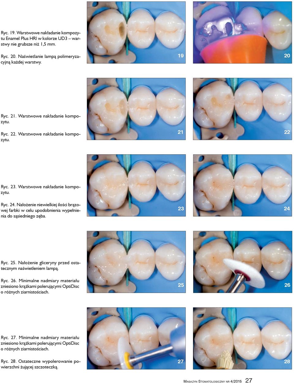 Nałożenie niewielkiej ilości brązowej farbki w celu upodobnienia wypełnienia do sąsiedniego zęba. 23 24 Ryc. 25. Nałożenie gliceryny przed ostatecznym naświetleniem lampą. Ryc. 26.