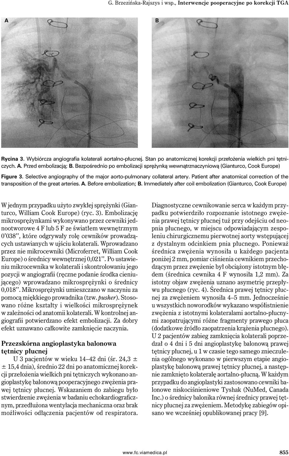Patient after anatomical correction of the transposition of the great arteries.. efore embolization;.