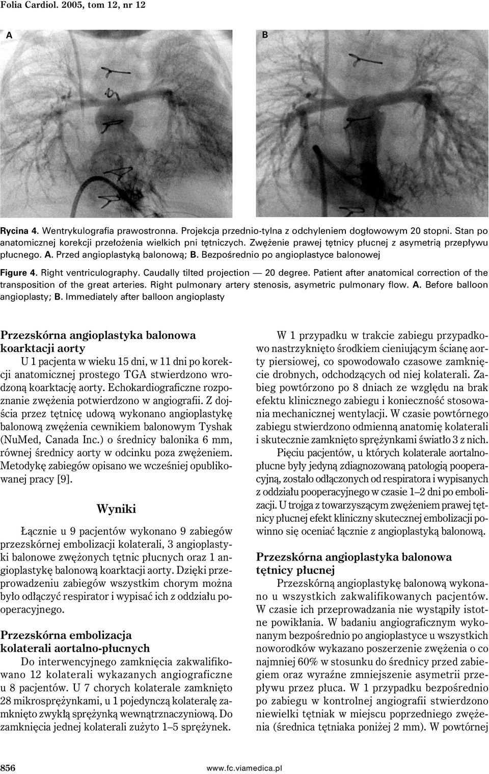 ezpośrednio po angioplastyce balonowej Figure 4. Right ventriculography. Caudally tilted projection 20 degree. Patient after anatomical correction of the transposition of the great arteries.