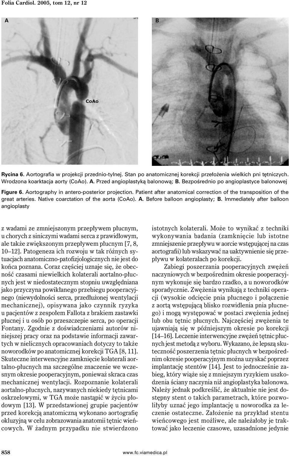 Patient after anatomical correction of the transposition of the great arteries. Native coarctation of the aorta (Coo).. efore balloon angioplasty;.