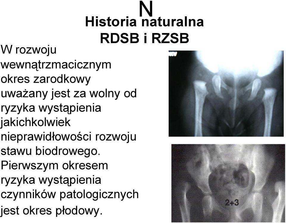 rozwoju stawu biodrowego.