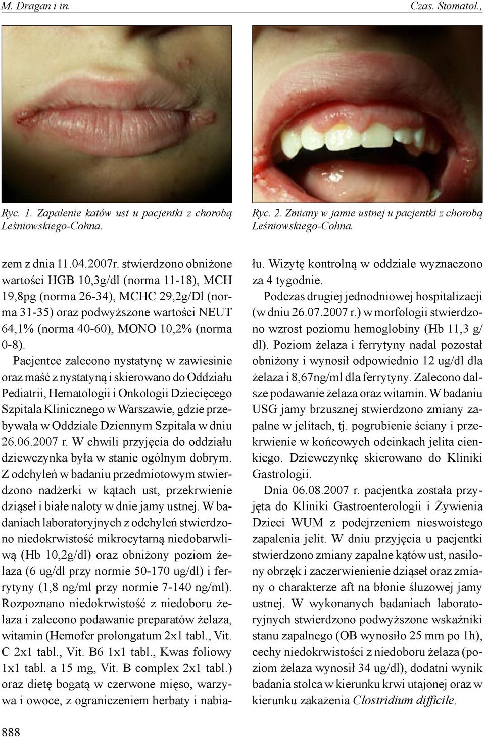 Pacjentce zalecono nystatynę w zawiesinie oraz maść z nystatyną i skierowano do Oddziału Pediatrii, Hematologii i Onkologii Dziecięcego Szpitala Klinicznego w Warszawie, gdzie przebywała w Oddziale