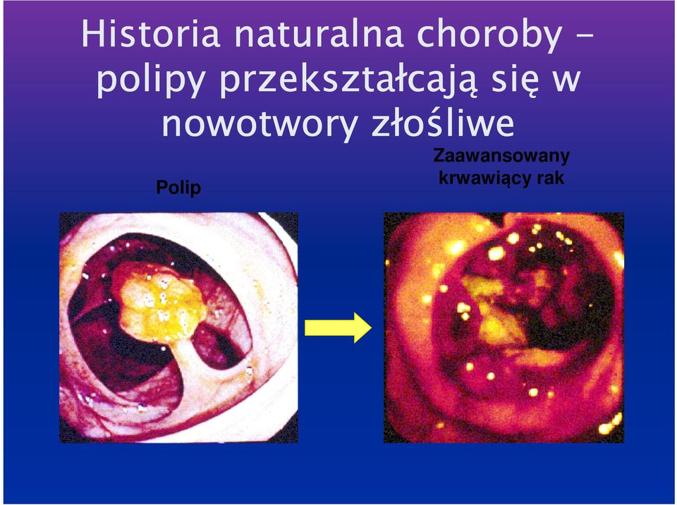 się w nowotwory złośliwe
