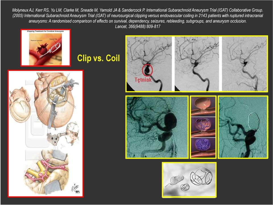(2005) International Subarachnoid Aneurysm Trial (ISAT) of neurosurgical clipping versus endovascular coiling in