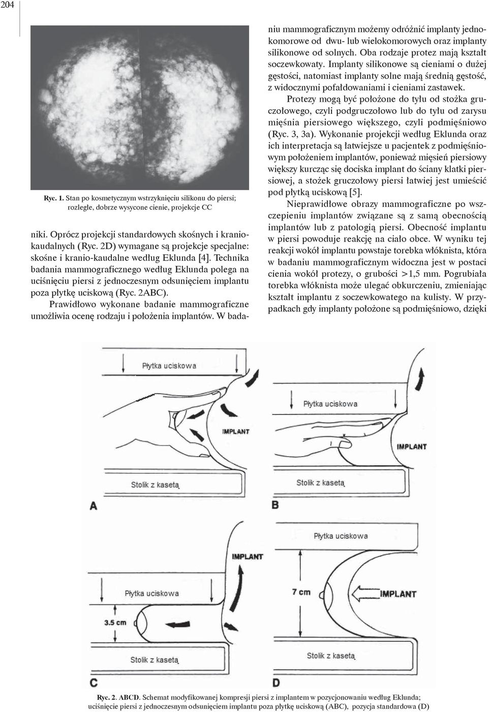 Technika badania mammograficznego według Eklunda polega na uciśnięciu piersi z jednoczesnym odsunięciem implantu poza płytkę uciskową (Ryc. 2ABC).
