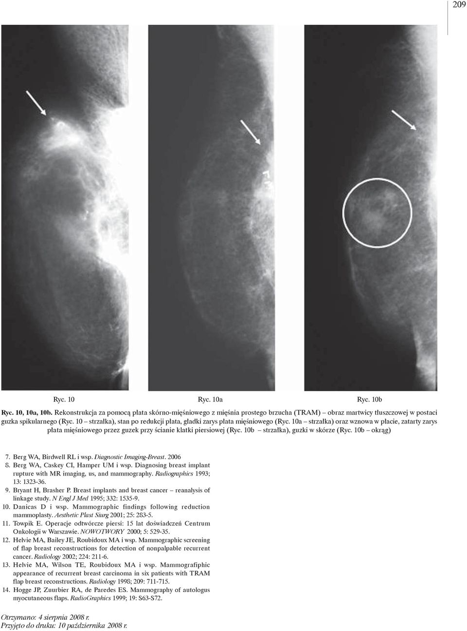 10b strzałka), guzki w skórze (Ryc. 10b okrąg) 7. Berg WA, Birdwell RL i wsp. Diagnostic Imaging-Breast. 2006 8. Berg WA, Caskey CI, Hamper UM i wsp.