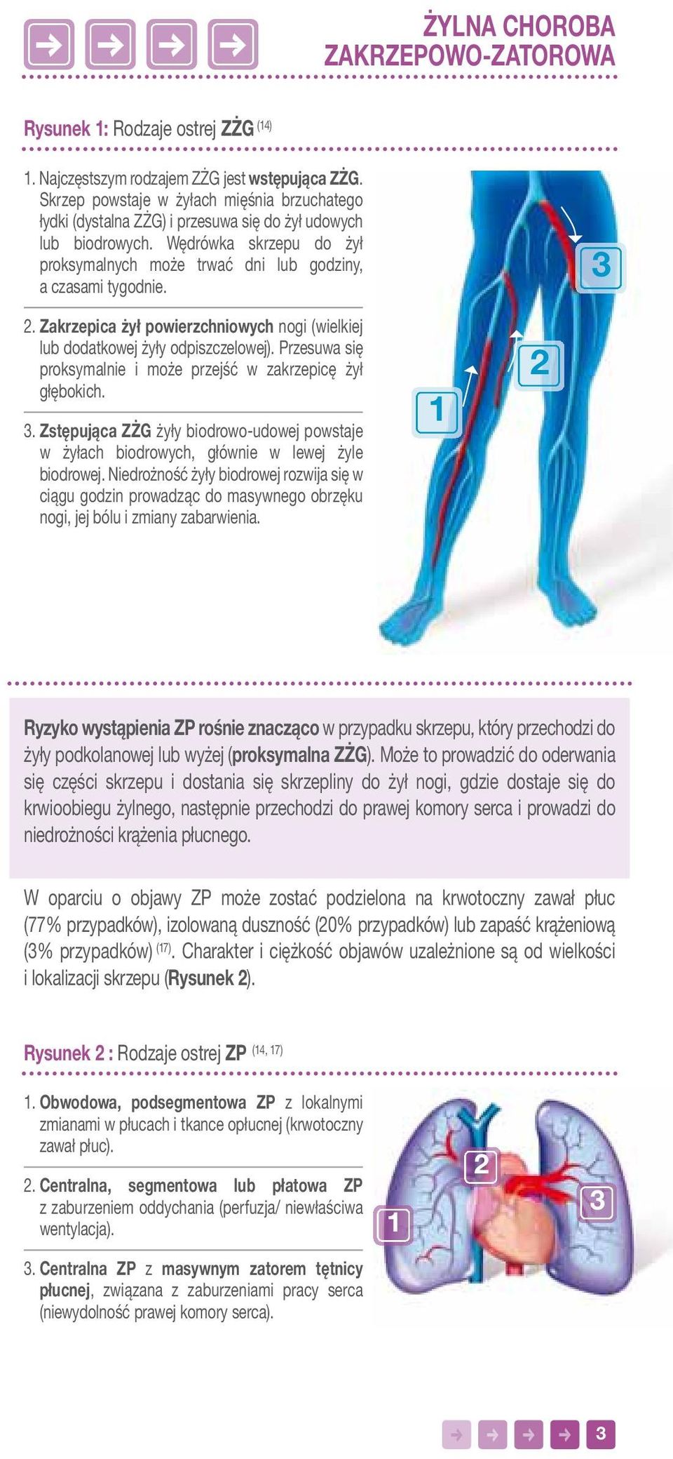 3 2. Zakrzepica żył powierzchniowych nogi (wielkiej lub dodatkowej żyły odpiszczelowej). Przesuwa się proksymalnie i może przejść w zakrzepicę żył głębokich. 3.