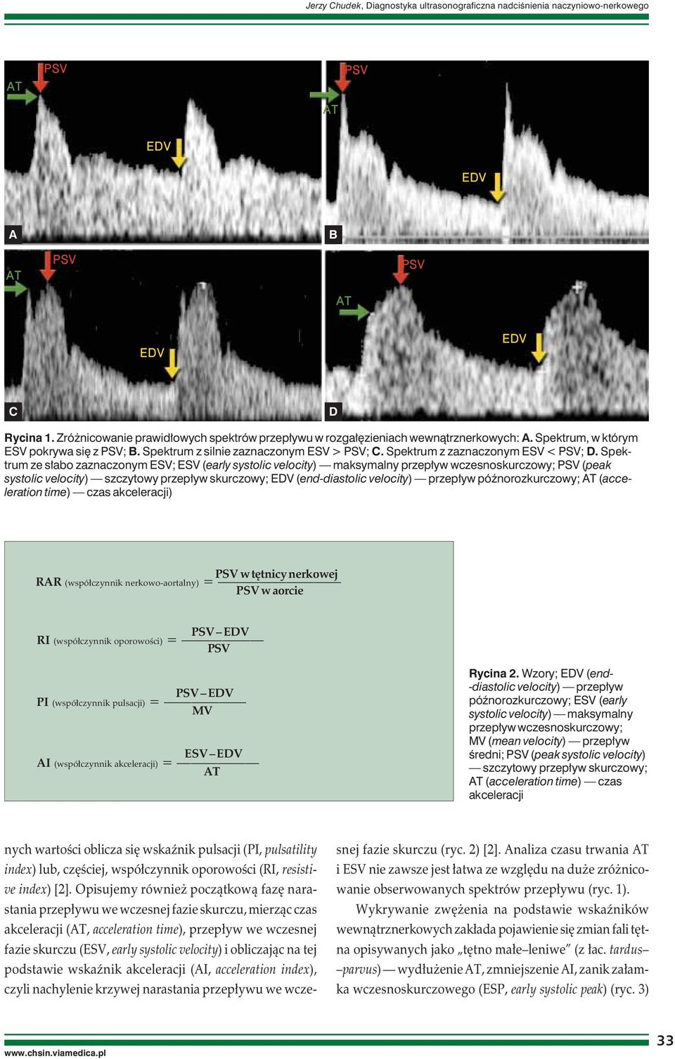 Spektrum ze słabo zaznaczonym ESV; ESV (early systolic velocity) maksymalny przepływ wczesnoskurczowy; (peak systolic velocity) szczytowy przepływ skurczowy; (end-diastolic velocity) przepływ