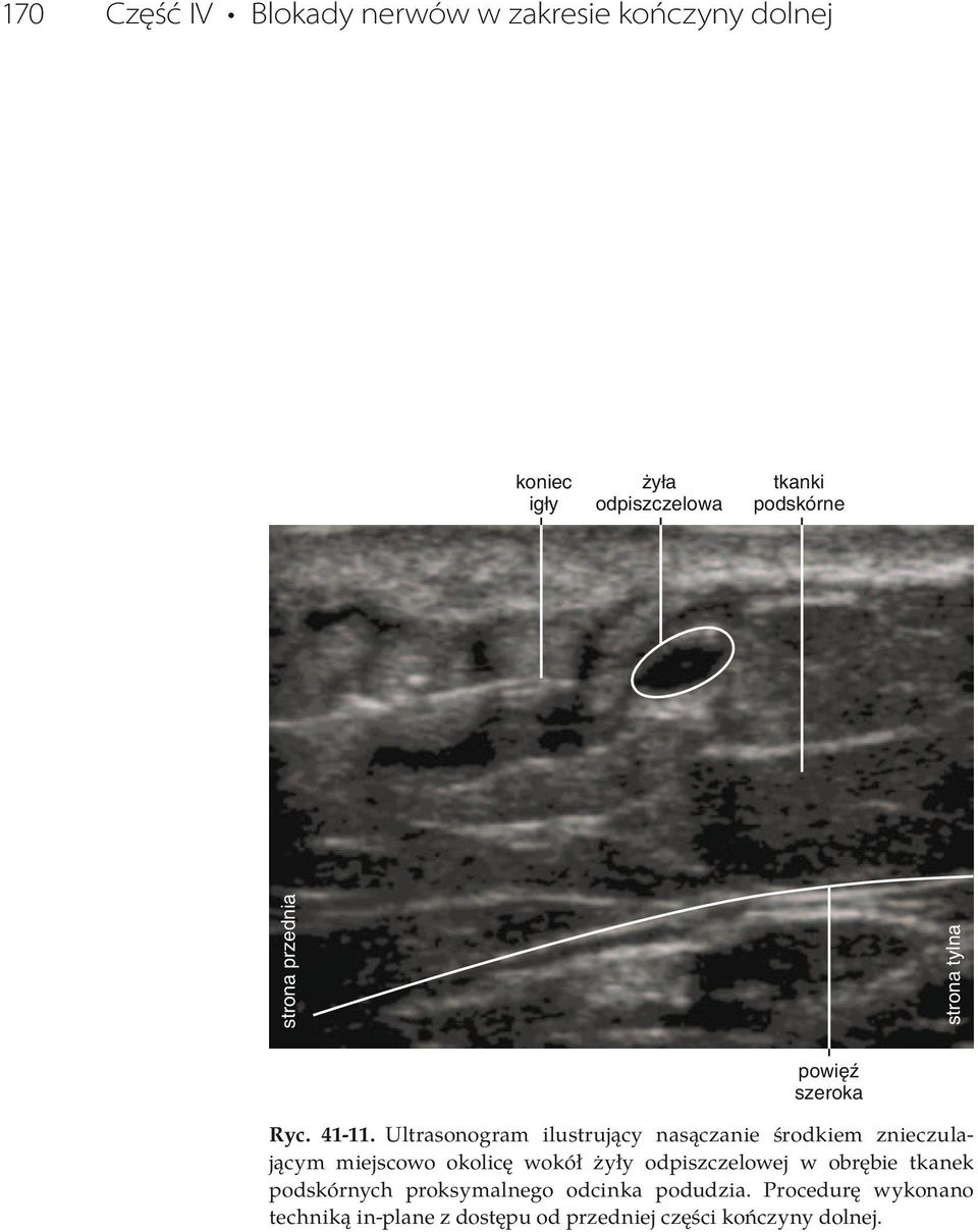 Ultrasonogram ilustrujący nasączanie środkiem znieczulającym okolicę wokół żyły
