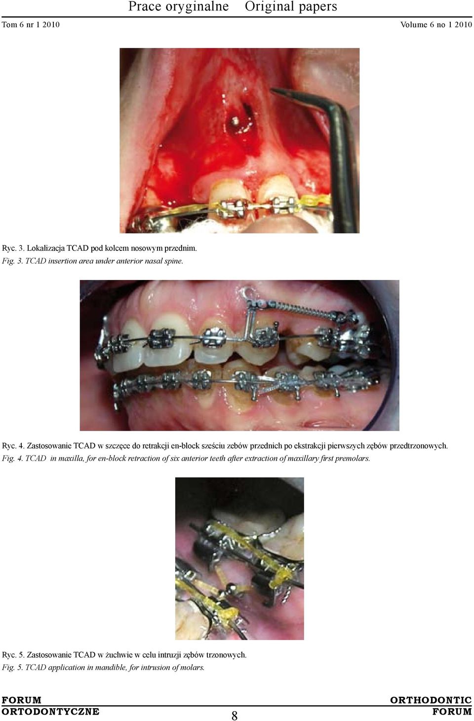 Fig. 4. TCAD in maxilla, for en-block retraction of six anterior teeth after extraction of maxillary first premolars. Ryc.