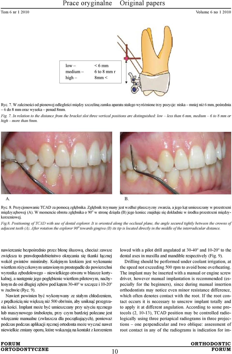 W momencie obrotu zgłębnika o 90º w stronę dziąsła (B) jego koniec znajduje się dokładnie w środku przestrzeni międzykorzeniowej. Fig.8. Positioning of TCAD with use of dental explorer.