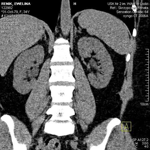 Obraz nerek przed podaniem kontrastu