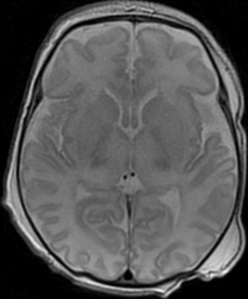 USG: wzmożona echogeniczność półkul mózgu w MR niepokoją nas raczej jądra podstawy i wzgórza nasz