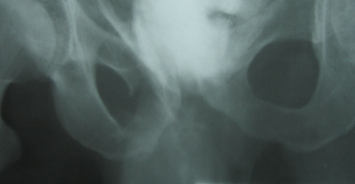 Typ IV pęknięcie zaotrzewnowe pęcherza USG płyn w przestrzeni okołopęcherzowej Cystografia, TK cieniujący mocz w przestrzeni zaotrzewnowej, w