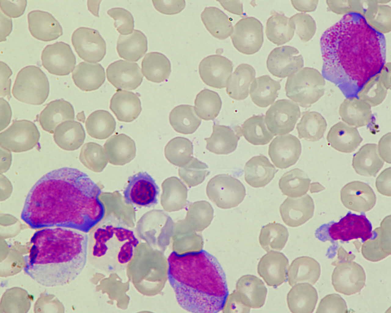 t/ostra białaczka promielocytowa(apl) Krótki czas do rozwoju białaczki<3 lat(po inhibitorach topoizomerazy II-antracykliny, mitoxantron, rzadziej VP16) Najczęściej po leczeniu raka piersi i