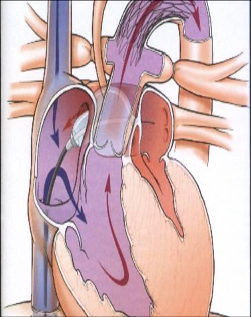 Serce jednokomorowe Wiele synonimów - pojedyńcza komora (single ventricle), - komora dwunapływowa (double inlet ventricle), - serce