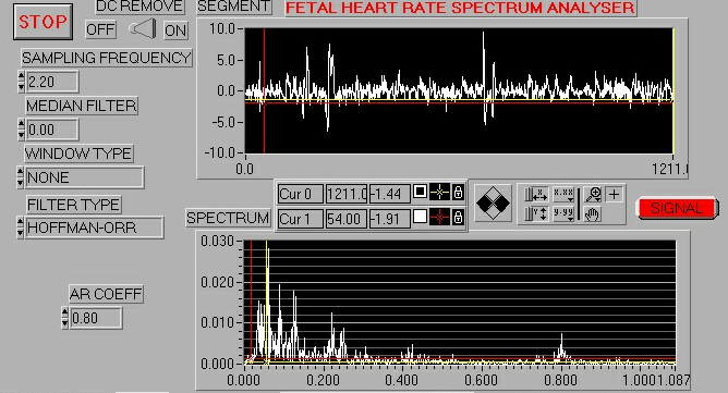 INFORMACJA SYGNAŁOWA ELEKTROKARDIOGRAFIA ELEKTROENCEFALOGRAFIA ELEKTROMIOGRAFIA