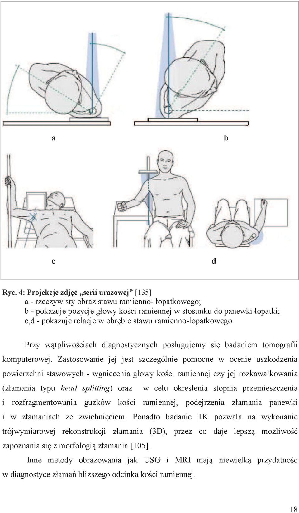 stawu ramienno-łopatkowego Przy wątpliwościach diagnostycznych posługujemy się badaniem tomografii komputerowej.