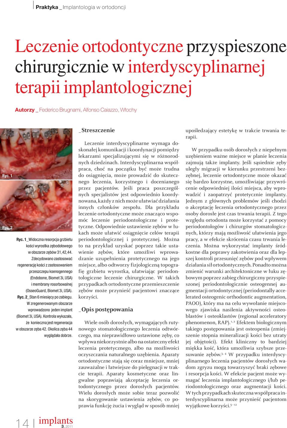 Zdecydowano zastosowaç regeneracj koêci z zastosowaniem przeszczepu ksenogennego (Endobone, Biomet 3i, USA) i membrany rosorbowalnej (OsseoGuard, Biomet 3i, USA). Ryc. 2_Stan 6 miesi cy po zabiegu.