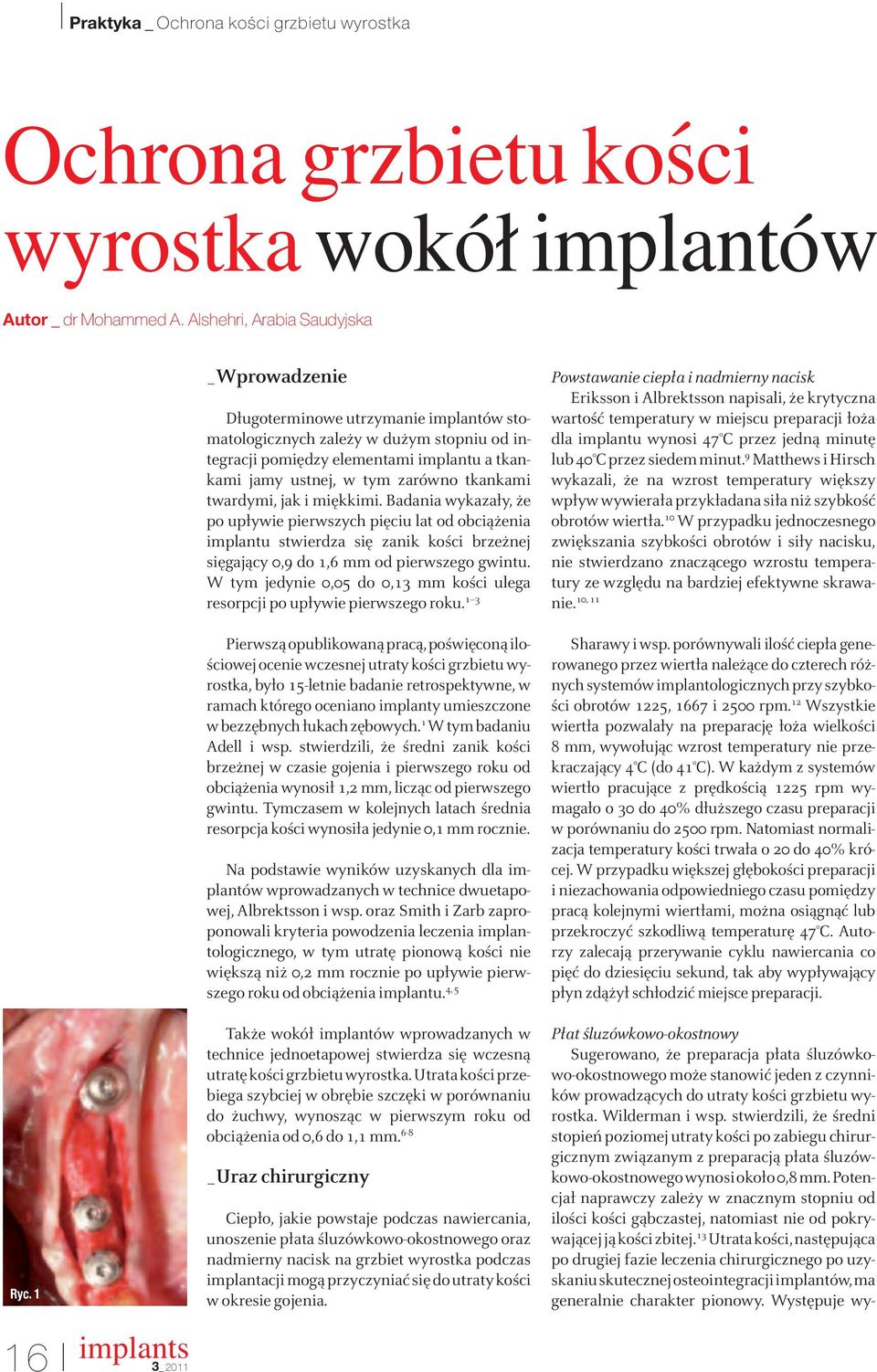 jak i miękkimi. Badania wykazały, że po upływie pierwszych pięciu lat od obciążenia implantu stwierdza się zanik kości brzeżnej sięgający 0,9 do 1,6 mm od pierwszego gwintu.