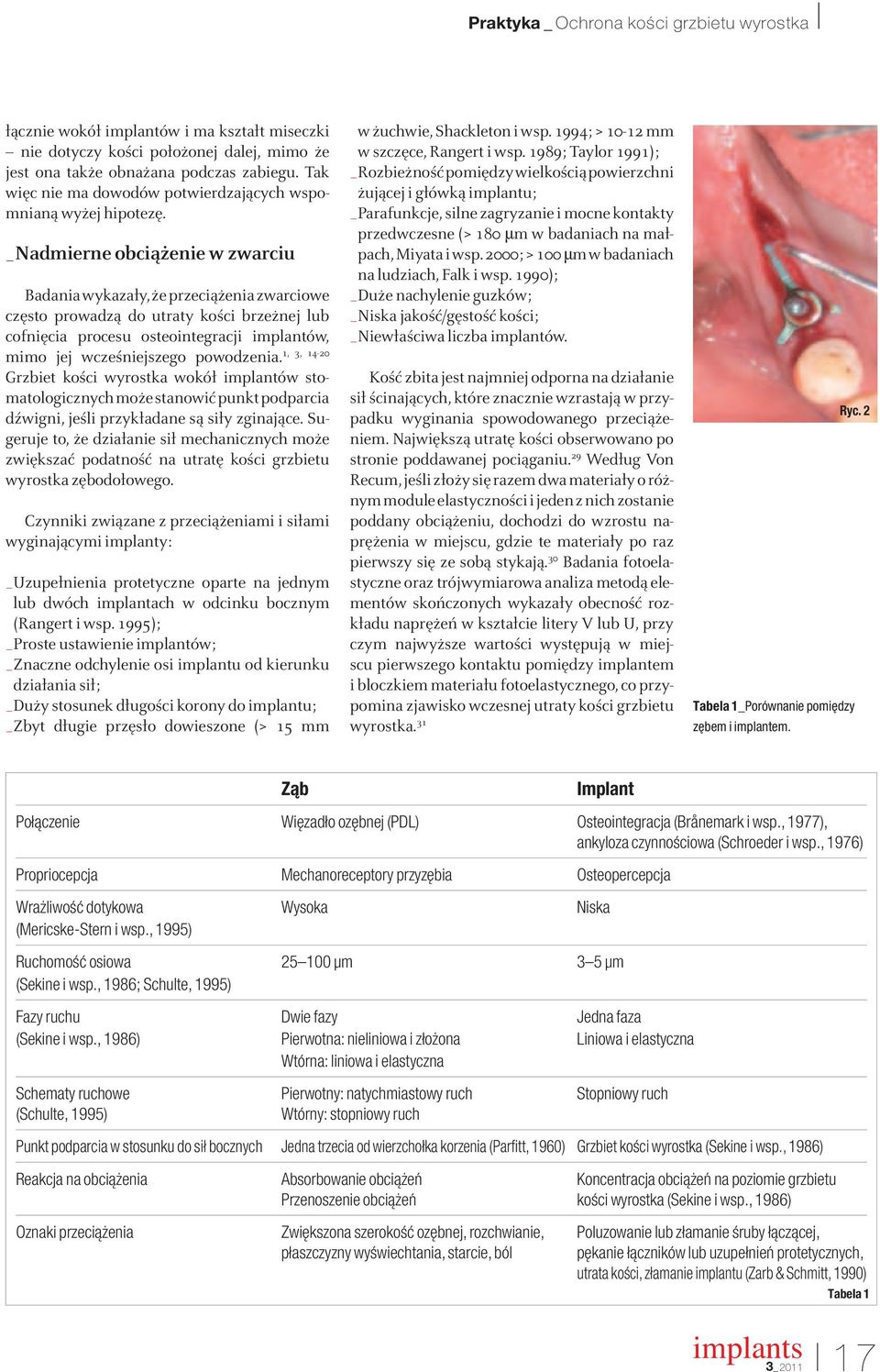 _Nadmierne obciążenie w zwarciu Badania wykazały, że przeciążenia zwarciowe często prowadzą do utraty kości brzeżnej lub cofnięcia procesu osteointegracji implantów, 1, 3, 14-20 mimo jej