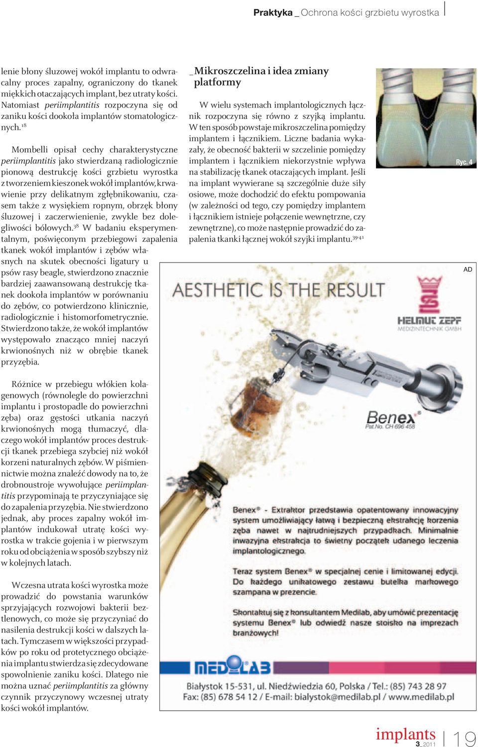 18 Mombelli opisał cechy charakterystyczne periimplantitis jako stwierdzaną radiologicznie pionową destrukcję kości grzbietu wyrostka z tworzeniem kieszonek wokół implantów, krwawienie przy