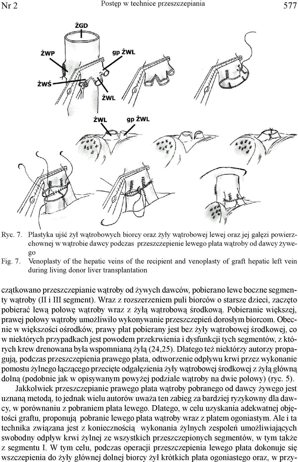 Plastyka ujœæ y³ w¹trobowych biorcy oraz y³y w¹trobowej lewej oraz jej ga³êzi powierzchownej w w¹trobie dawcy podczas przeszczepienie lewego p³ata w¹troby od dawcy ywego Venoplasty of the hepatic