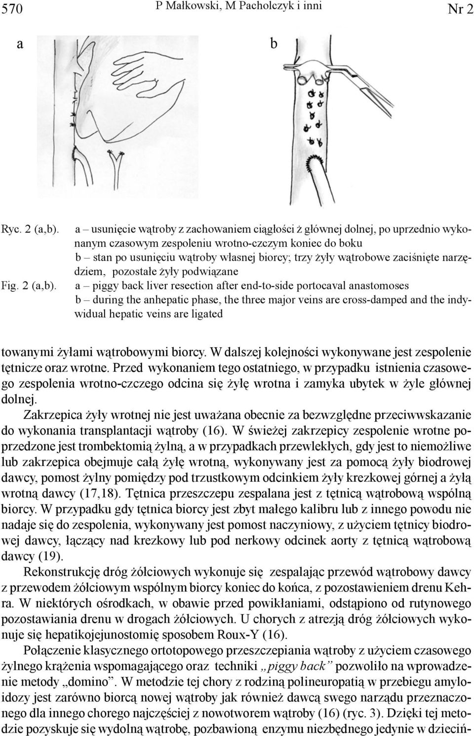 a usuniêcie w¹troby z zachowaniem ci¹g³oœci g³ównej dolnej, po uprzednio wykonanym czasowym zespoleniu wrotno-czczym koniec do boku b stan po usuniêciu w¹troby w³asnej biorcy; trzy y³y w¹trobowe