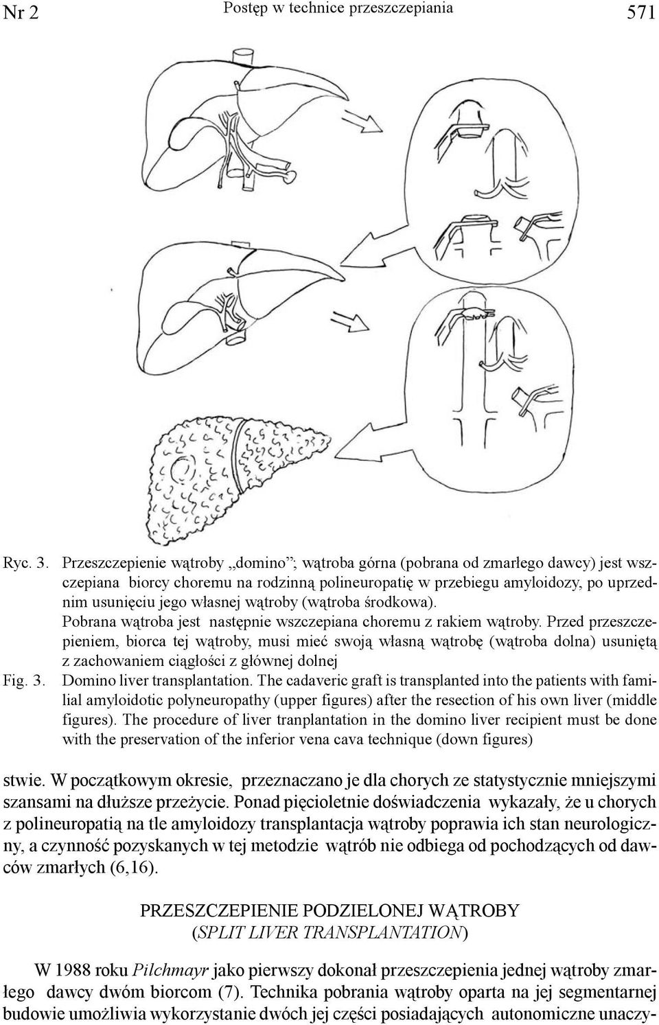Przeszczepienie w¹troby domino ; w¹troba górna (pobrana od zmar³ego dawcy) jest wszczepiana biorcy choremu na rodzinn¹ polineuropatiê w przebiegu amyloidozy, po uprzednim usuniêciu jego w³asnej