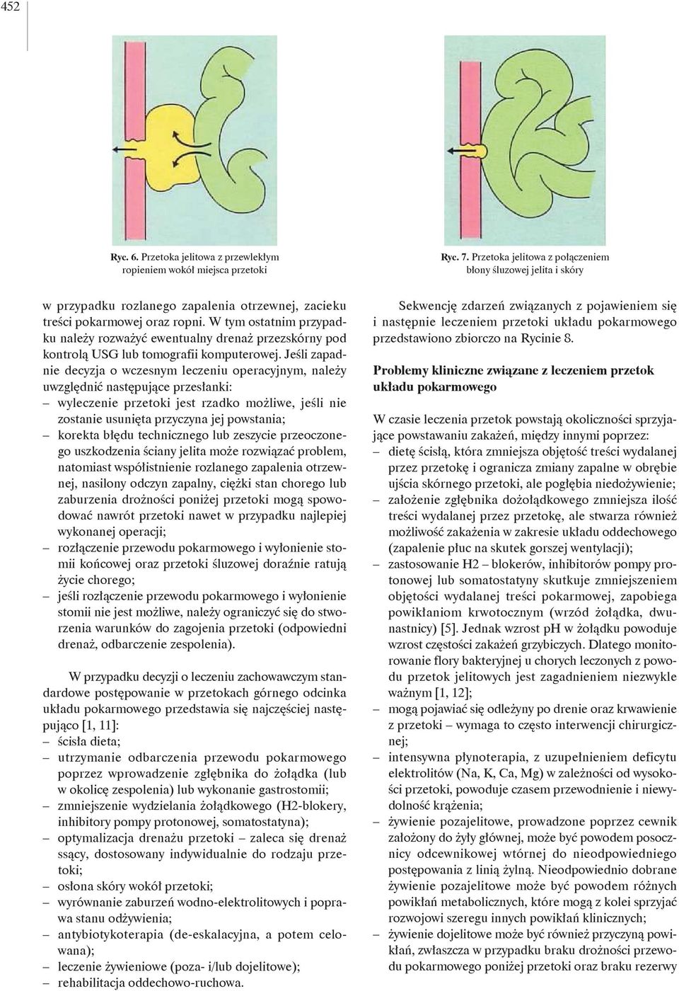 W tym ostatnim przypadku należy rozważyć ewentualny drenaż przezskórny pod kontrolą USG lub tomografii komputerowej.