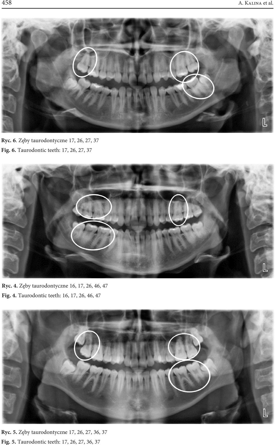 , 47 Fig. 4. Taurodontic teeth: 16, 17, 26, 46, 47 Ryc. 5.