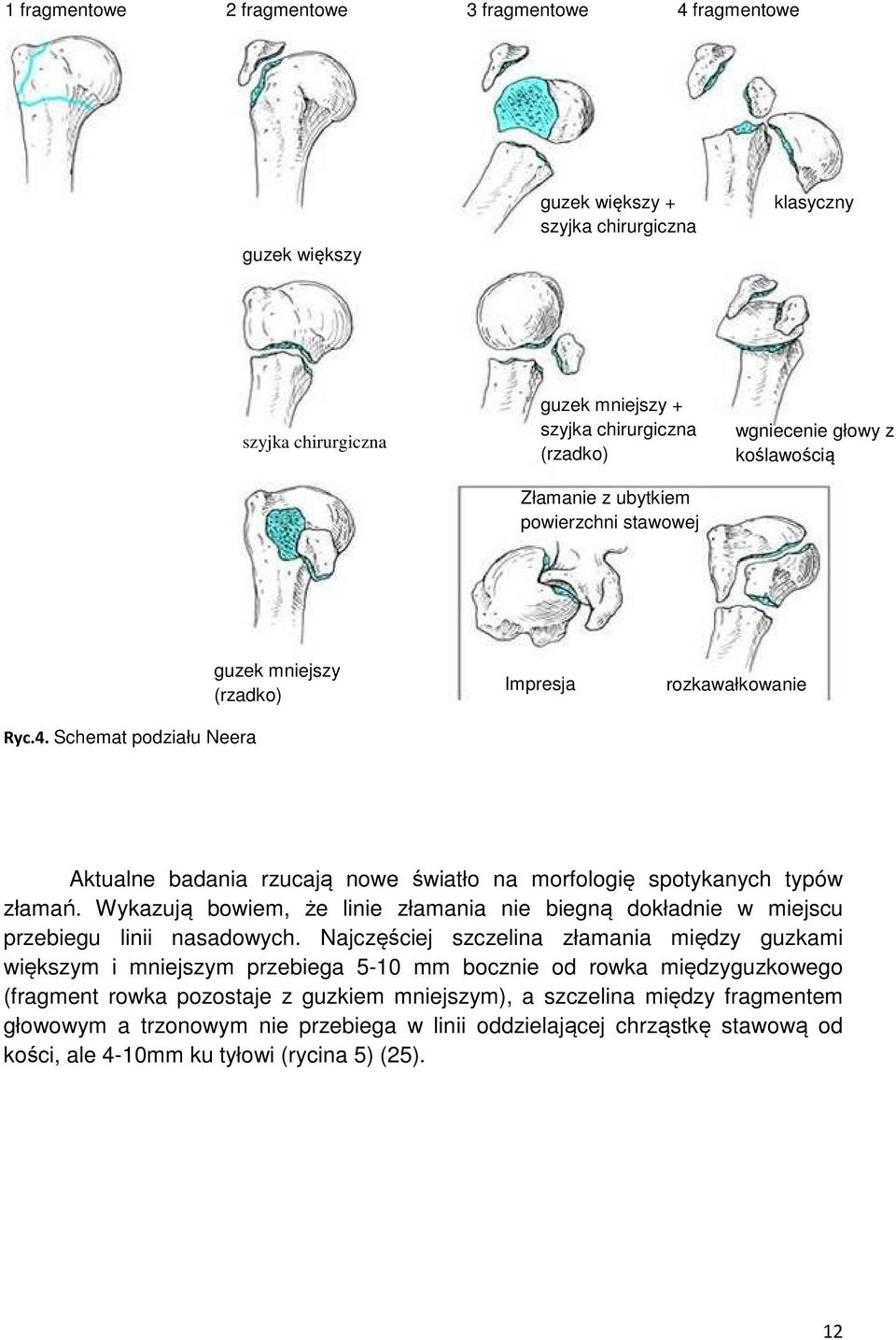 Schemat podziału Neera guzek mniejszy (rzadko) Impresja rozkawałkowanie Aktualne badania rzucają nowe światło na morfologię spotykanych typów złamań.