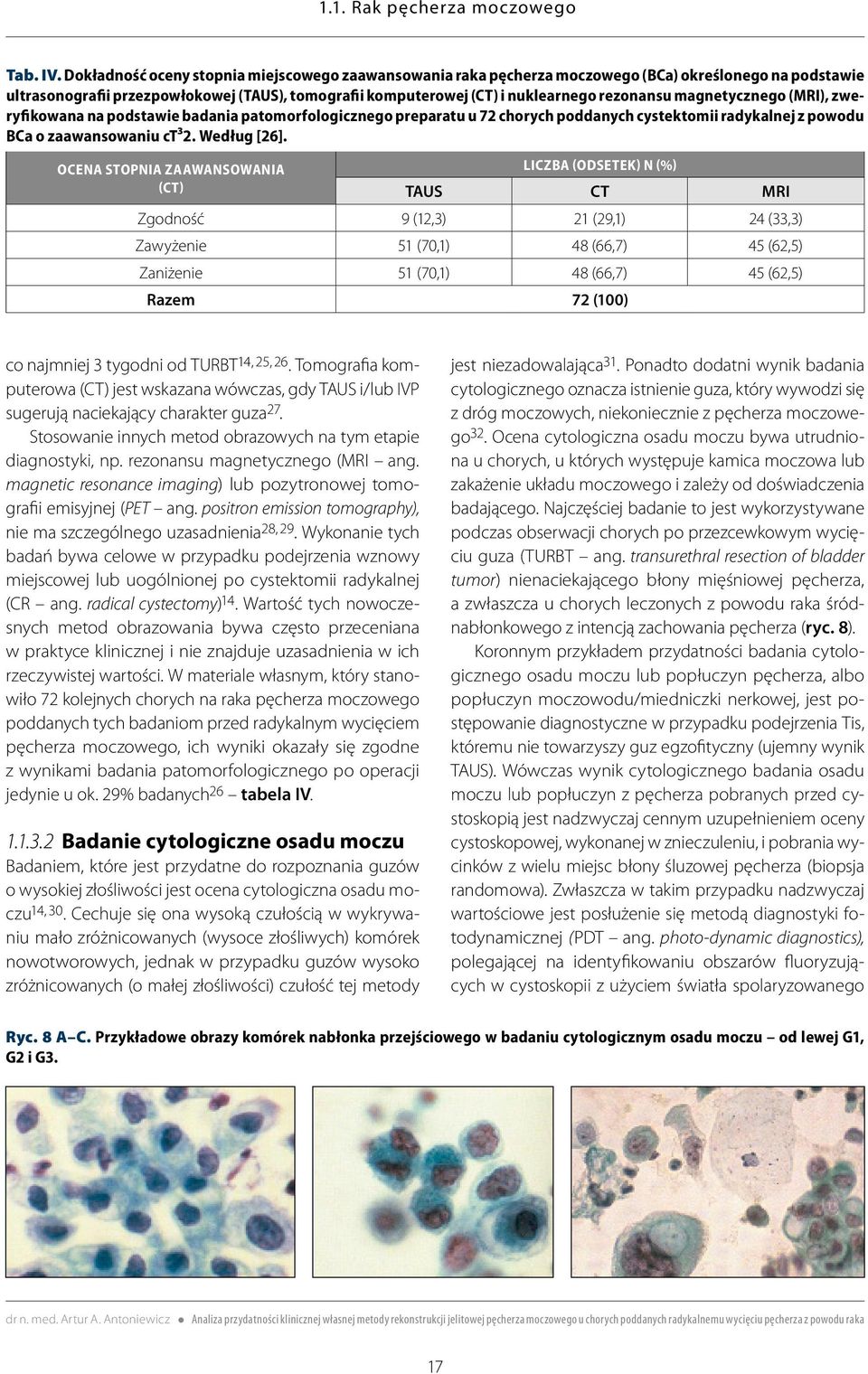 magnetycznego (MRI), zweryfikowana na podstawie badania patomorfologicznego preparatu u 72 chorych poddanych cystektomii radykalnej z powodu BCa o zaawansowaniu ct³2. Według [26].