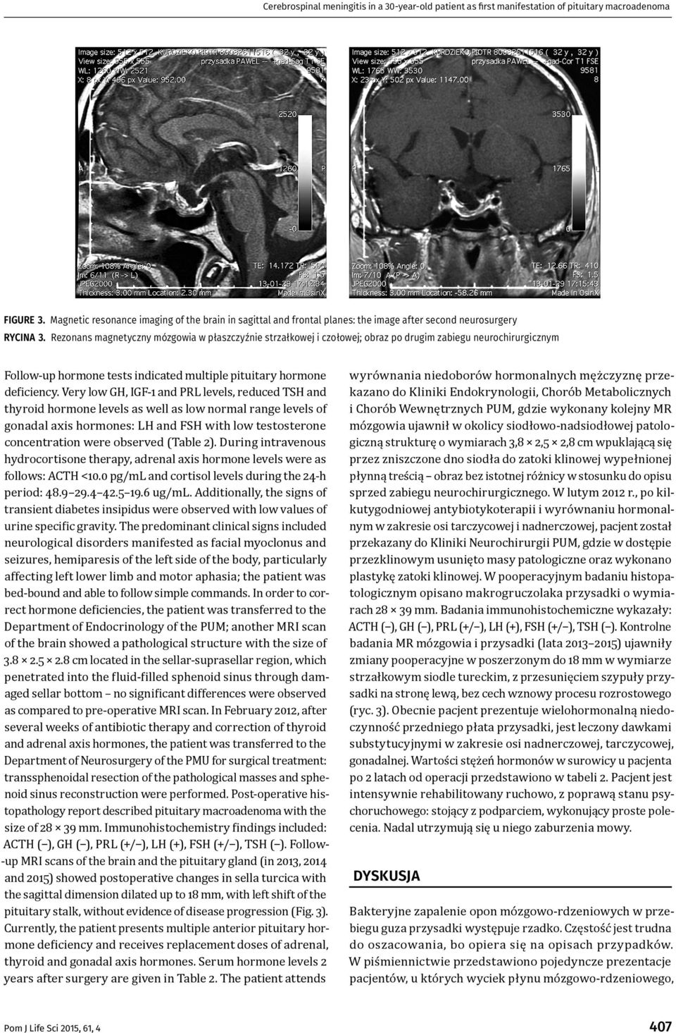 Rezonans magnetyczny mózgowia w płaszczyźnie strzałkowej i czołowej; obraz po drugim zabiegu neurochirurgicznym Follow -up hormone tests indicated multiple pituitary hormone de iciency.