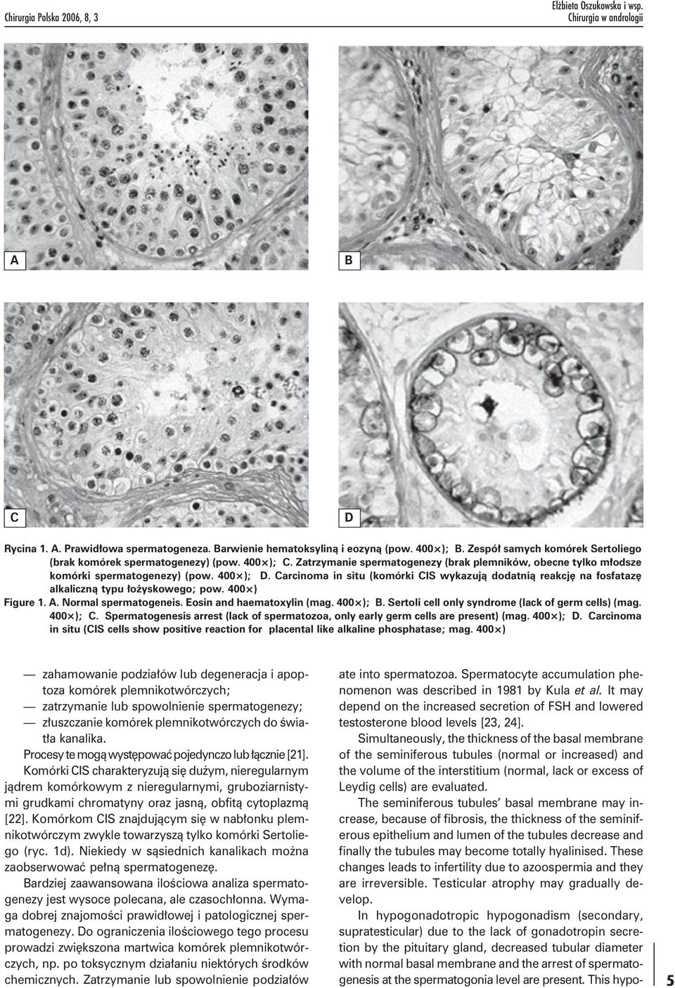 Carcinoma in situ (komórki CIS wykazują dodatnią reakcję na fosfatazę alkaliczną typu łożyskowego; pow. 400 ) Figure 1. A. Normal spermatogeneis. Eosin and haematoxylin (mag. 400 ); B.