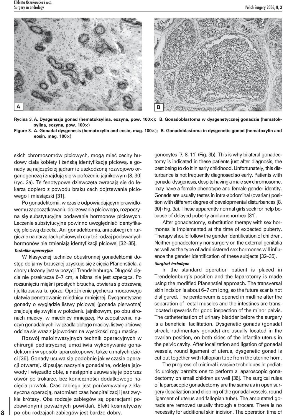 Gonadoblastoma in dysgenetic gonad (hematoxylin and eosin, mag.