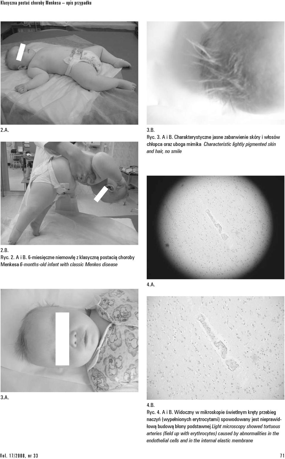 6-miesięczne niemowlę z klasyczną postacią choroby Menkesa 6-months-old infant with classic Menkes disease 4.A. 3.A. 4.B. Ryc. 4. A i B.