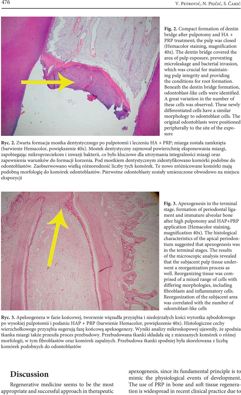 Beneath the dentin bridge formation, odontoblast-like cells were identified. A great variation in the number of these cells was observed.