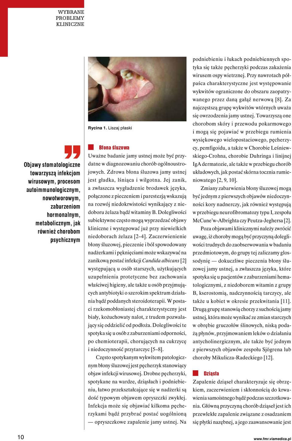 Jej zanik, a zwłaszcza wygładzenie brodawek języka, połączone z pieczeniem i parestezją wskazują na rozwój niedokrwistości wynikający z niedoboru żelaza bądź witaminy B.
