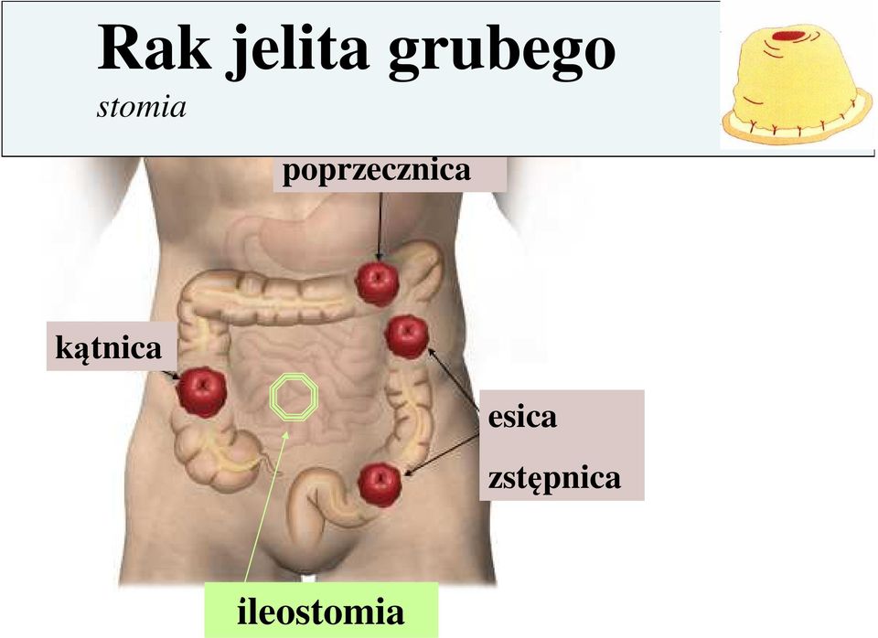 poprzecznica