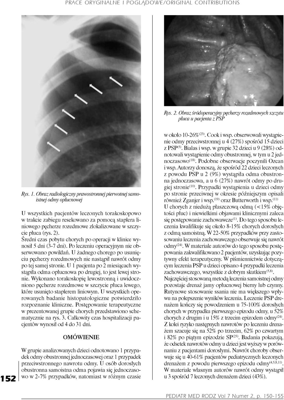 Obraz radiologiczny prawostronnej pierwotnej samoistnej odmy opłucnowej U wszystkich pacjentów leczonych torakoskopowo w trakcie zabiegu resekowano za pomocą staplera liniowego pęcherze rozedmowe