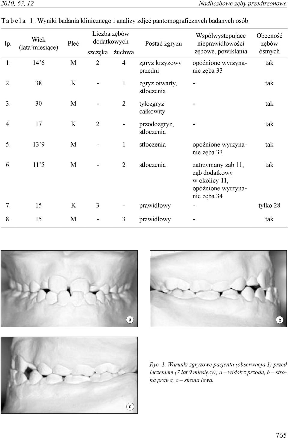 14 6 M 2 4 zgryz krzyżowy przedni Współwystępujące nieprawidłowości zębowe, powikłania opóźnione wyrzynanie zęba 33 Obecność zębów ósmych tak 2. 38 K - 1 zgryz otwarty, stłoczenia 3.