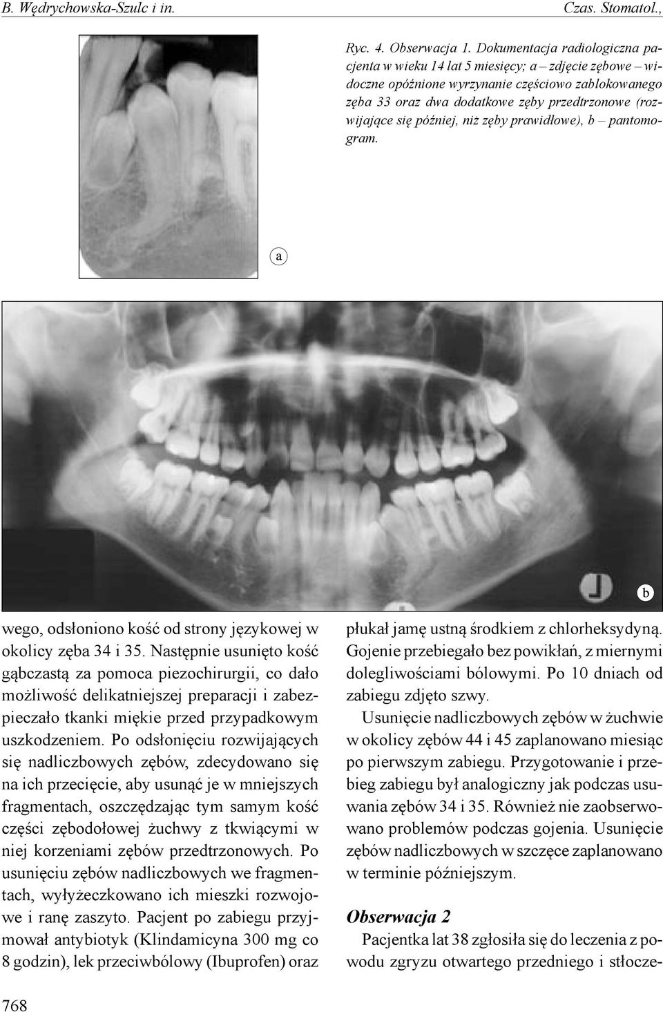 później, niż zęby prawidłowe), b pantomogram. wego, odsłoniono kość od strony językowej w okolicy zęba 34 i 35.