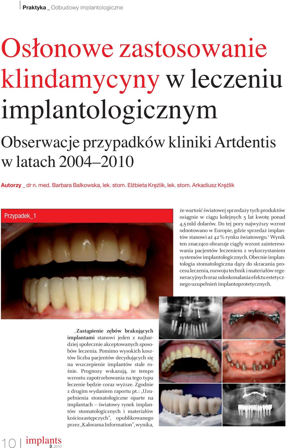 Do tej pory najwyższy wzrost odnotowano w Europie, gdzie sprzedaż implantów stanowi aż 42% rynku światowego.