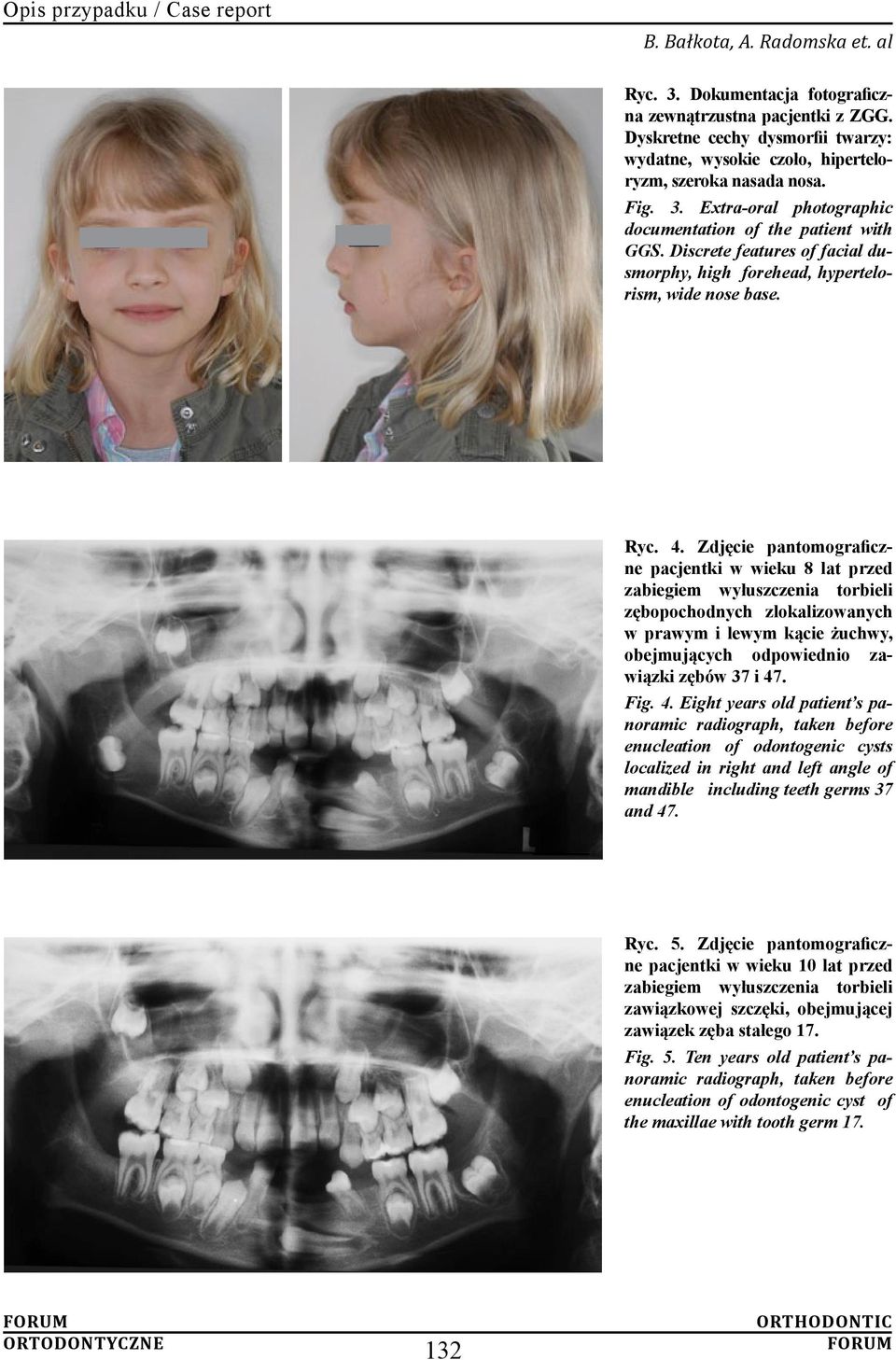 Discrete features of facial dusmorphy, high forehead, hypertelorism, wide nose base. Ryc. 4.