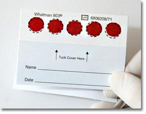 WYKONANIE BADANIA Do wykonania Omega Test wykorzystana jest analiza suchej kropli krwi (ang. dried blood spots - DBS).